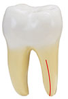 Vertical Root Fracture in Portsmouth